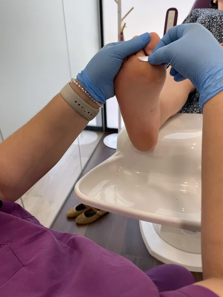 Tratamiento de papiloma plantar en consulta de podología